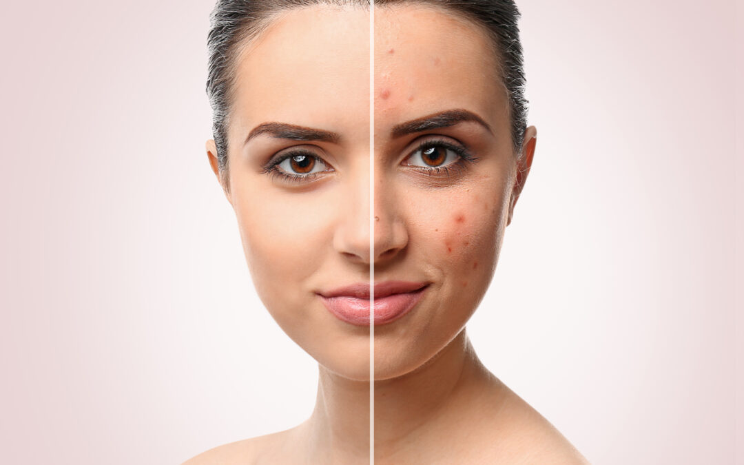 Acne Awareness Month: Understanding the Impact of Diet, Environment, and Hormones on Your Skin